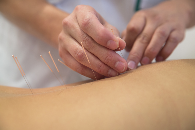 Treatment by acupuncture acupuncture